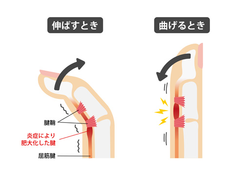 肥厚した腱が、指の付け根のところで引っ掛かり、パチンとバネのようになる症状