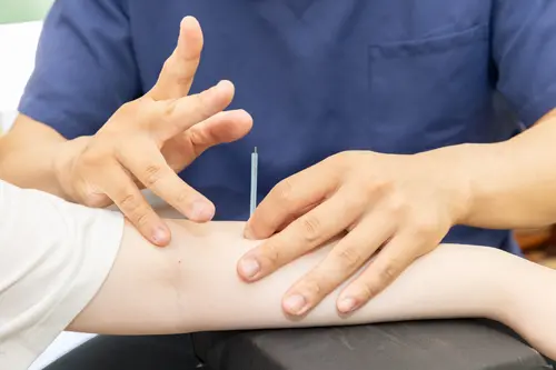 腕の鍼施術