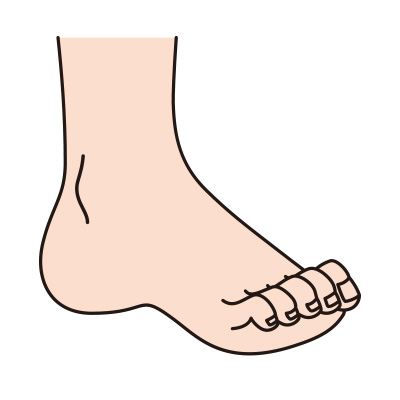 足の指に力を入れていなくても、足指がグッと力を入れた状態のように下向けに曲がってしまっている状態