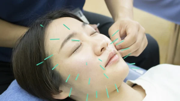 お顔のむくみ・たるみなど．．．お困りの方！美容鍼治療って受けたことありますか？