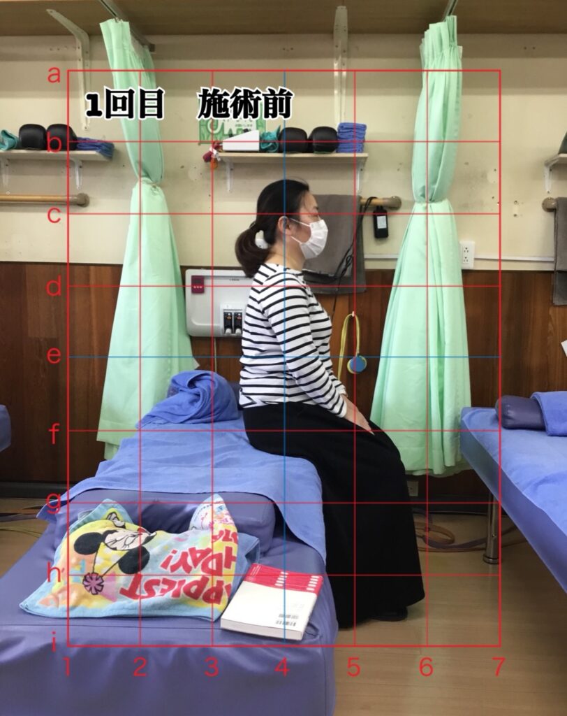 姿勢矯正コース1回目の施術前の姿勢(座位)