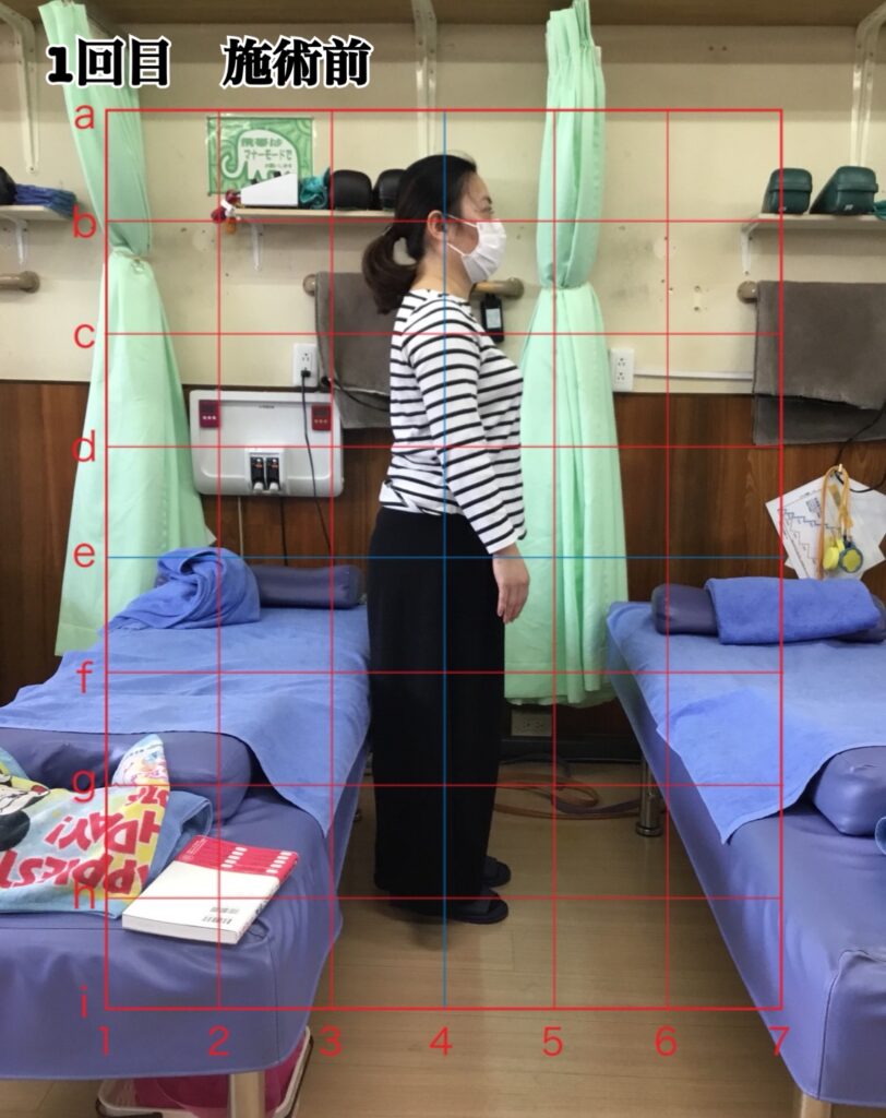姿勢矯正コース1回目の施術前の姿勢(立位)