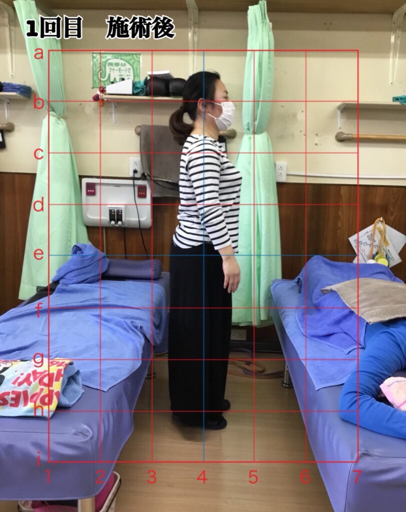 姿勢矯正コース1回目の施術後の姿勢(立位)