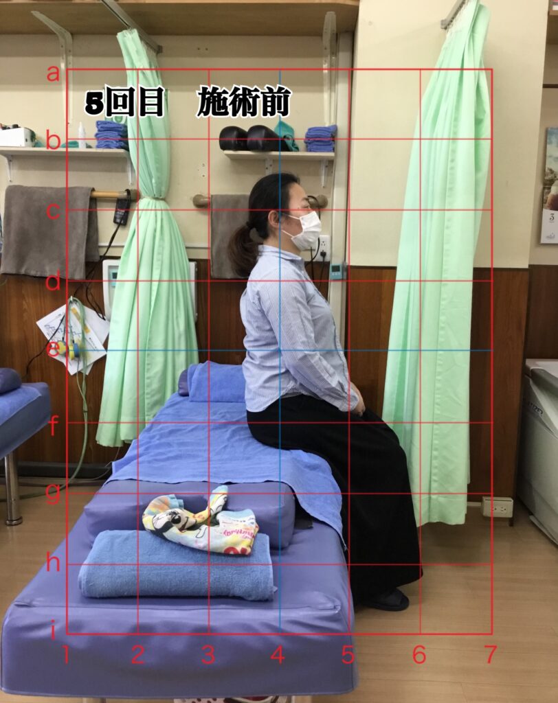 姿勢矯正コース5回目の施術前の姿勢(座位)