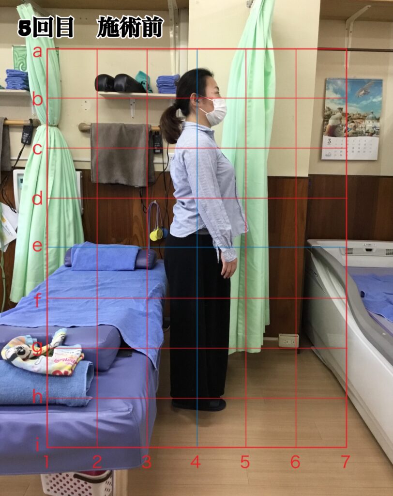 姿勢矯正コース5回目の施術前の姿勢(立位)