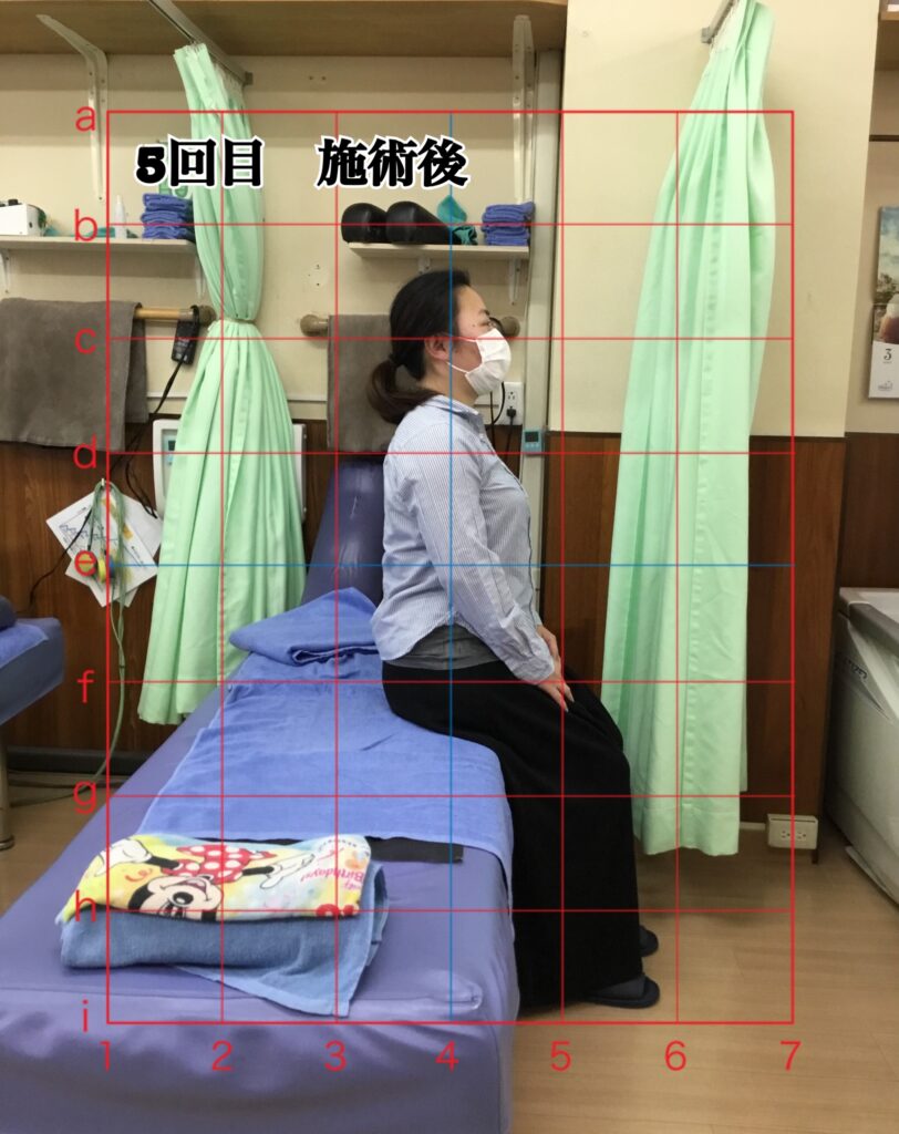 姿勢矯正コース5回目の施術後の姿勢(座位)