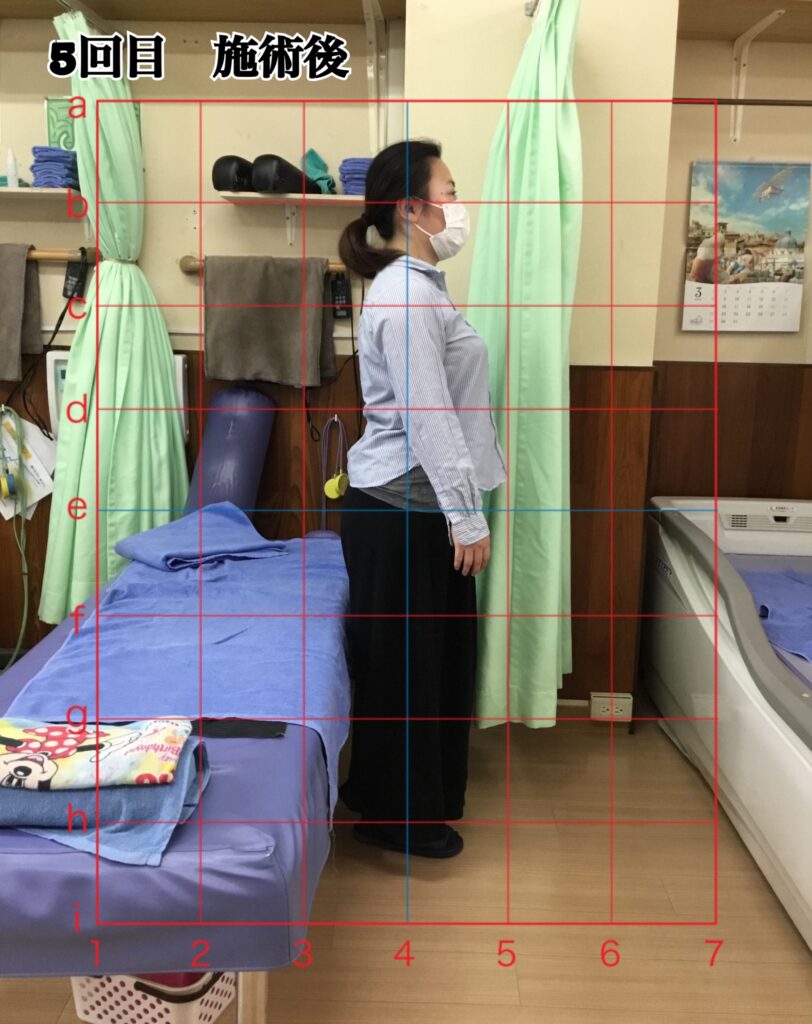 姿勢矯正コース5回目の施術後の姿勢(立位)