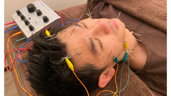 繊細なお顔の筋肉！むくみやたるみなど美容鍼が向いているわけとは？