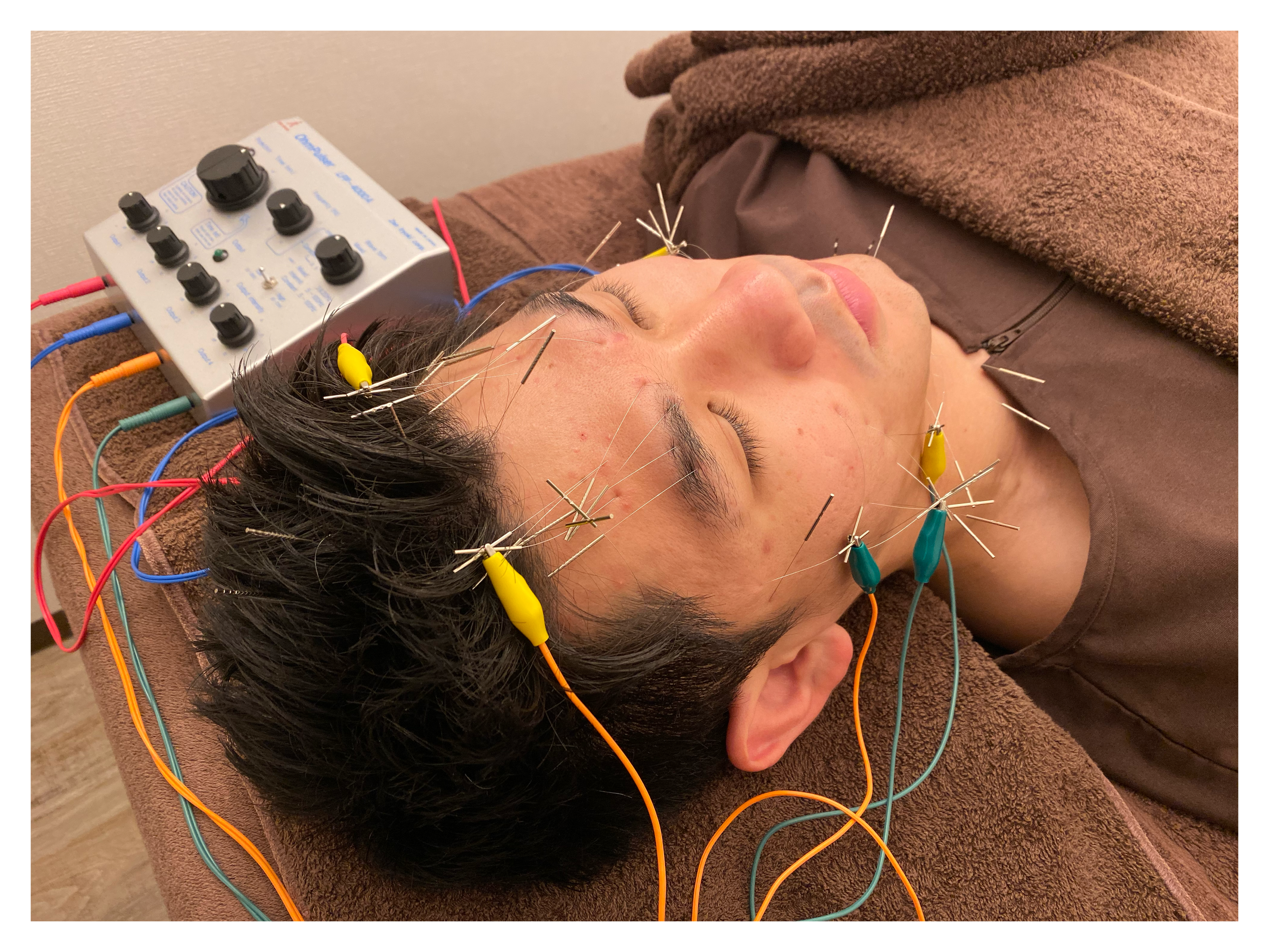 繊細なお顔の筋肉！むくみやたるみなど美容鍼が向いているわけとは？