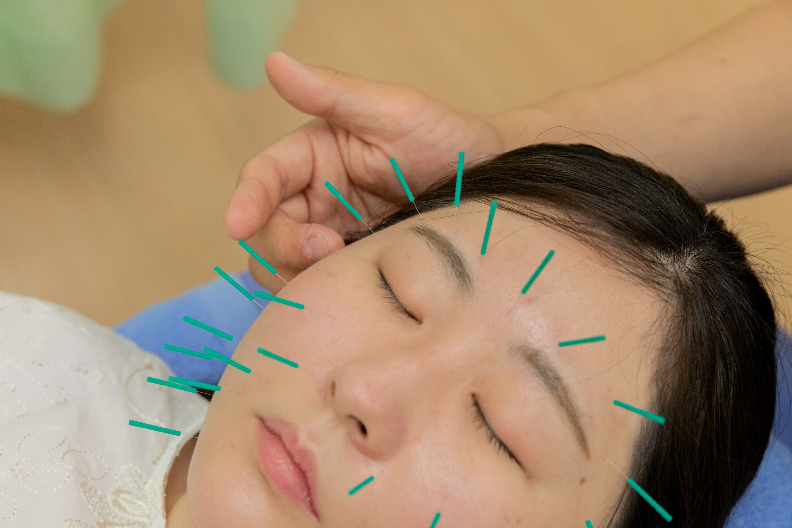 スタンダードコースの美容鍼施術中