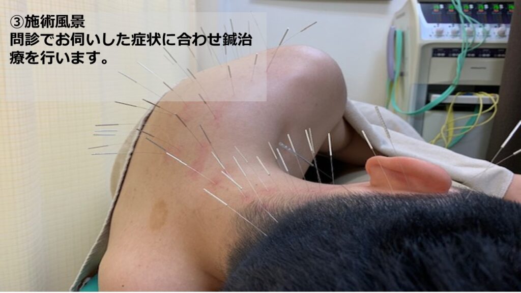 ③施術風景　問診でお伺いした症状に合わせ鍼治療を行います。