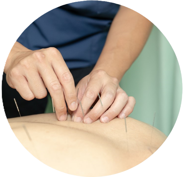 鍼施術画像