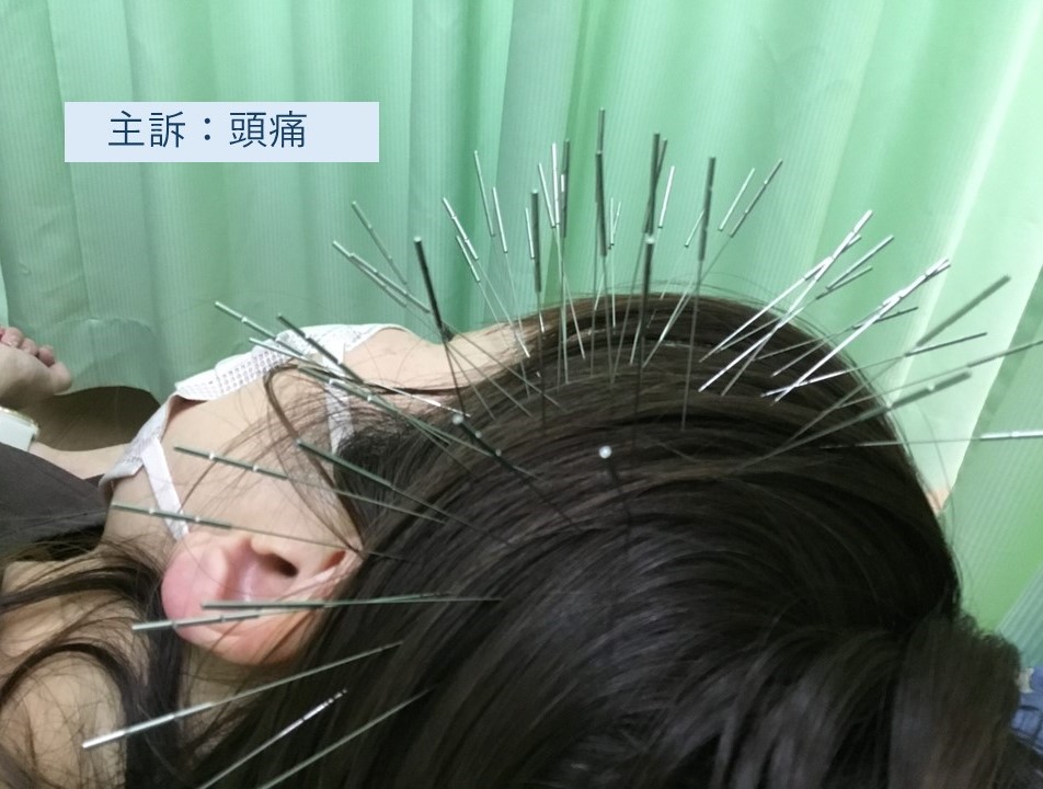 主訴:頭痛の施術
