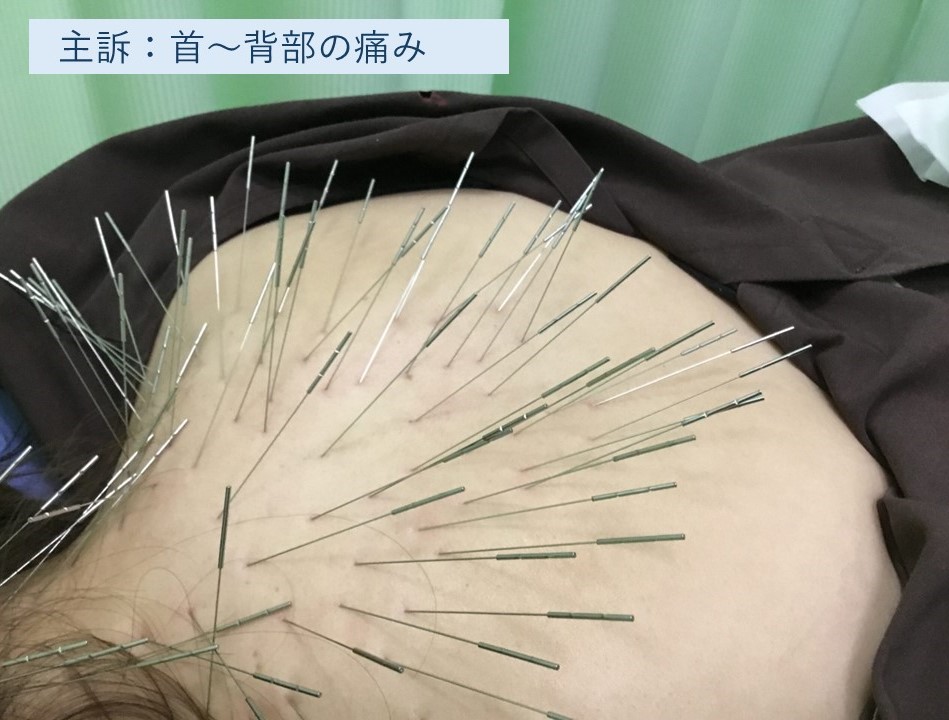 主訴:首〜背部の痛みに対する施術