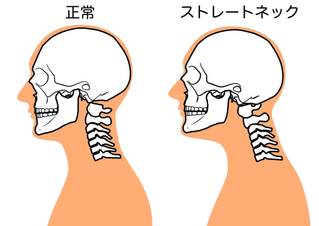 ストレートネックと正常な首の図解イラスト